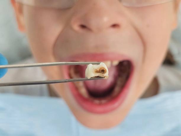 Best Emergency Tooth Extraction in Oswego, NY